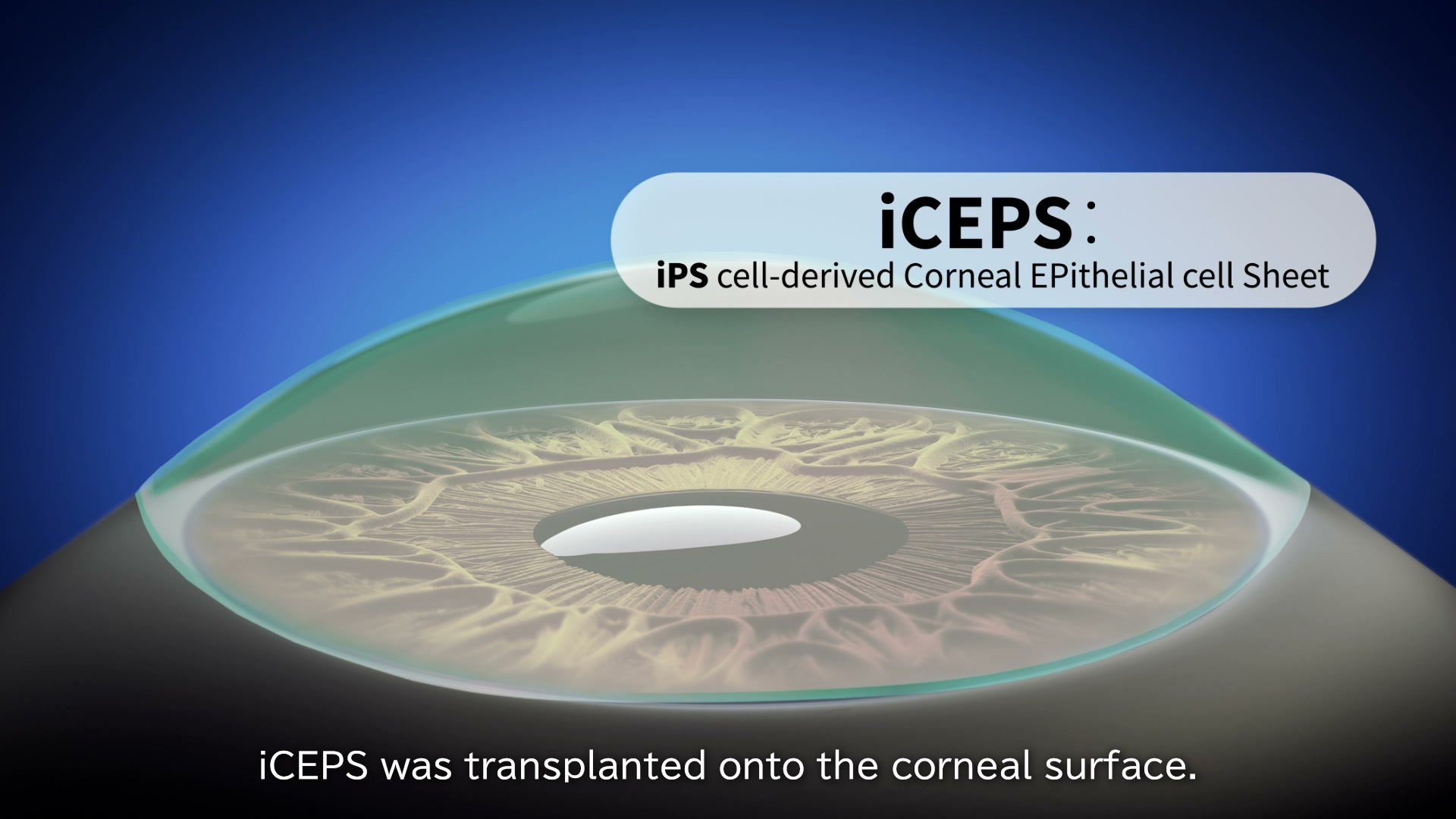 透明なiCEPSシートが角膜表面に移植された様子を示す画像